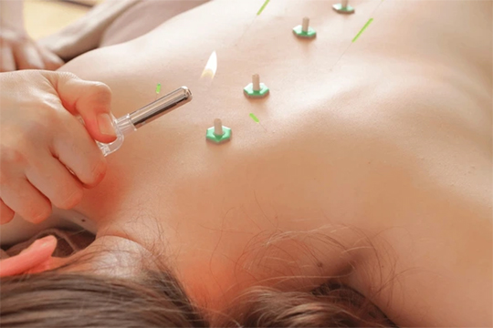 Moxibustion